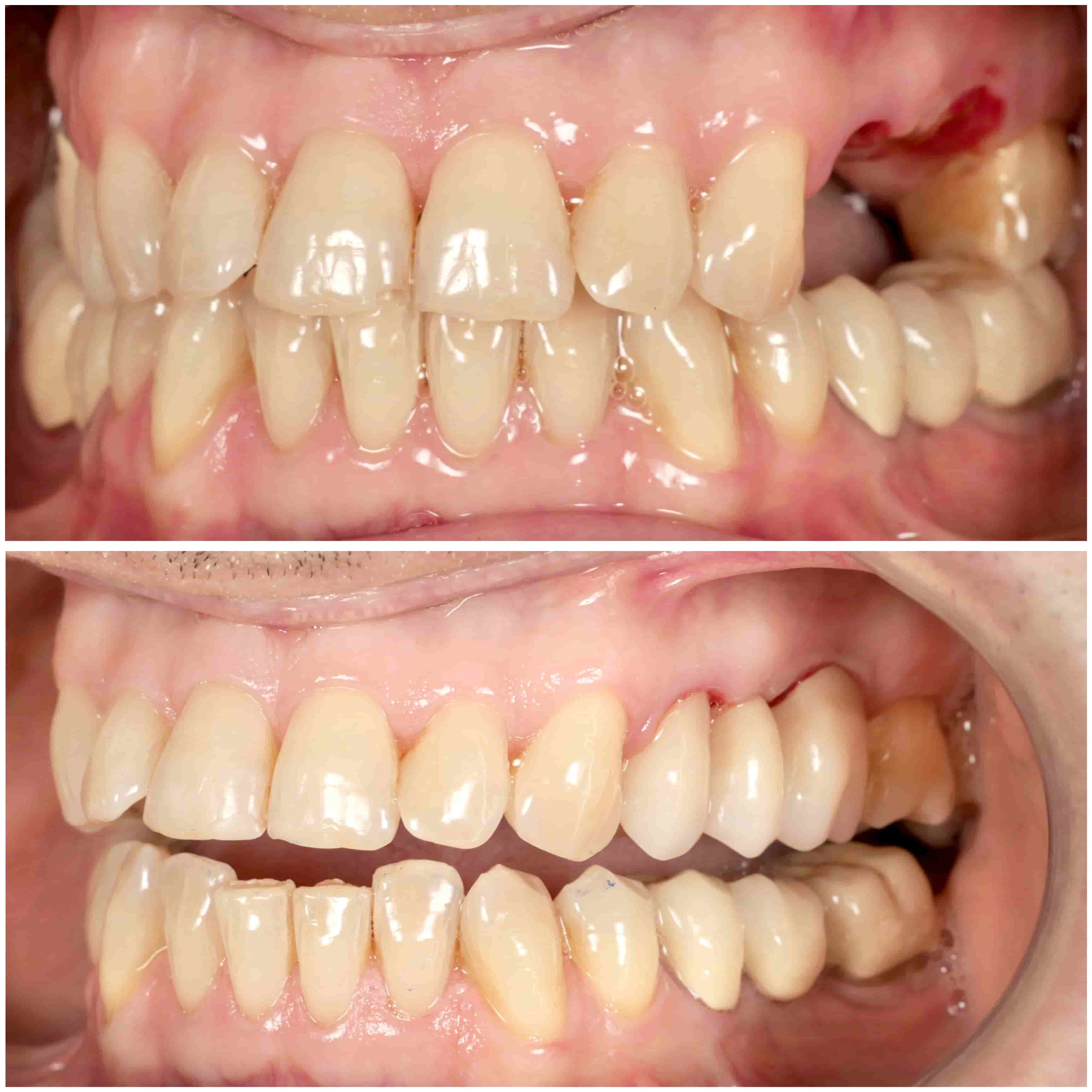 Chirurgia guidata implantare — Dott. Galeazzi, Bios Center Osimo